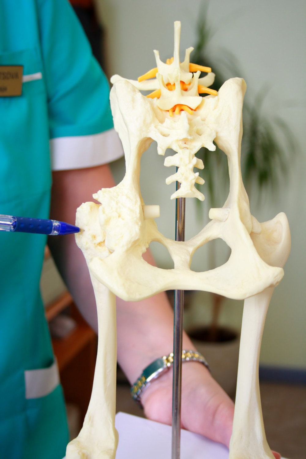 Hip-Dysplasia-Model